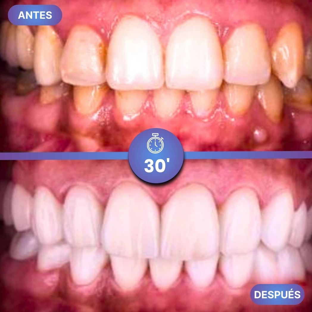 Dientes Blancos al Instante - GumiDent V34