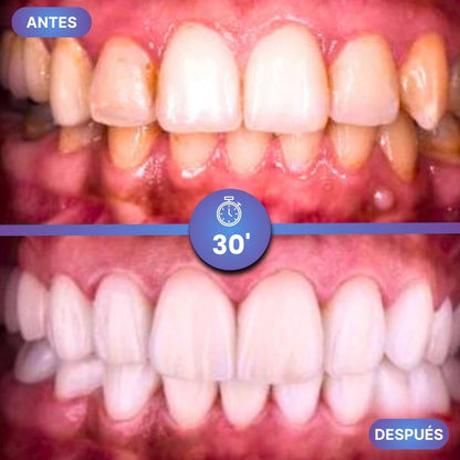 Dientes Blancos al Instante - GumiDent V34